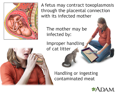 Congenital toxoplasmosis - Illustration Thumbnail              