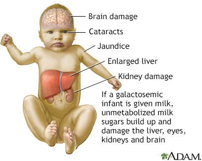 Galactosemia - Illustration Thumbnail              