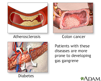 Gas gangrene - Illustration Thumbnail
                      