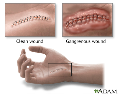 Gas gangrene - Illustration Thumbnail
                      