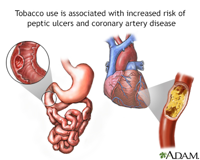 Tobacco and vascular disease - Illustration Thumbnail
              