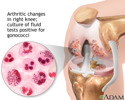 Gonococcal arthritis - Illustration Thumbnail
              