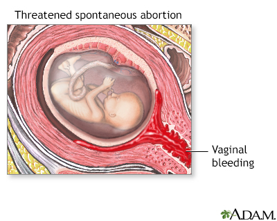 Threatened miscarriage