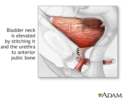 Stress incontinence - Illustration Thumbnail
                      