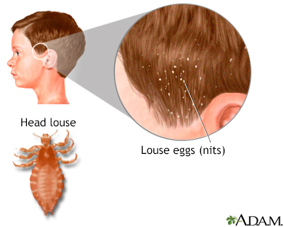 Head lice Information | Mount Sinai - New York