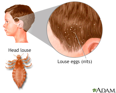 Head lice - Illustration Thumbnail              