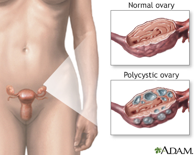 Stein-Leventhal syndrome - Illustration Thumbnail							