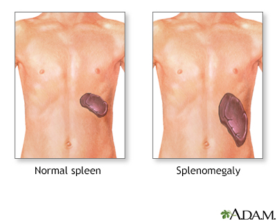 Splenomegaly - Illustration Thumbnail
              