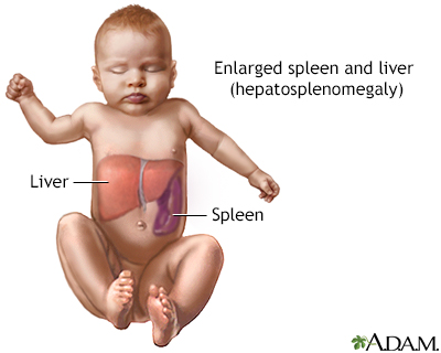 Hepatosplenomegaly - Illustration Thumbnail              