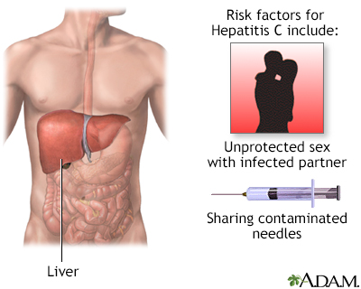 Hepatitis C - Illustration Thumbnail
                      