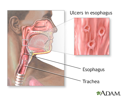 Herpetic esophagitis - Illustration Thumbnail
                      