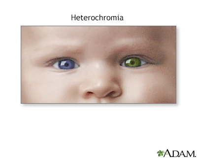 humans with two different eye colors