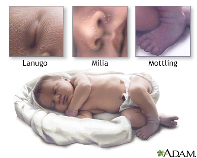 lanugo newborn