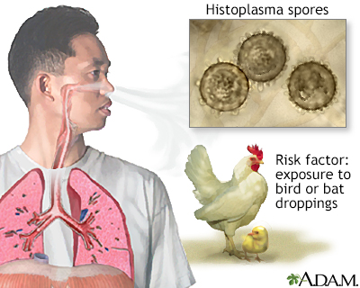 Histoplasmosis: causa, síntomas y tratamiento.