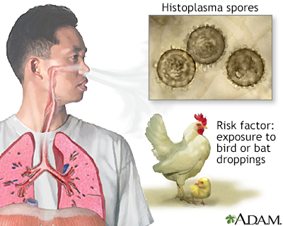 Acute histoplasmosis - Illustration Thumbnail
              