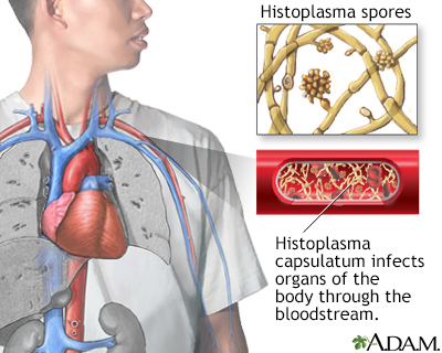 Disseminated histoplasmosis - Illustration Thumbnail
                      