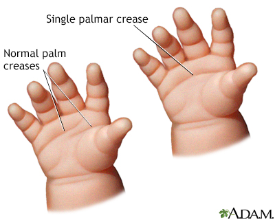 Palmar bilateral creases single Single transverse