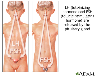 hypogonadism