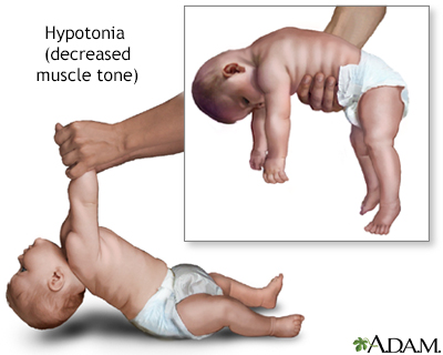 hypotonia