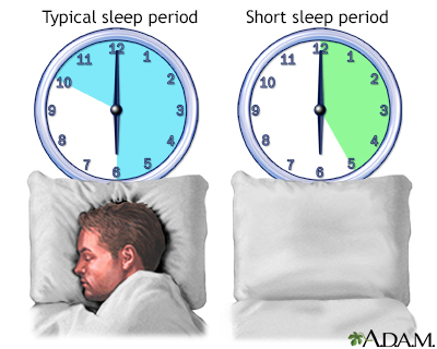 What is Short Sleep Syndrome?