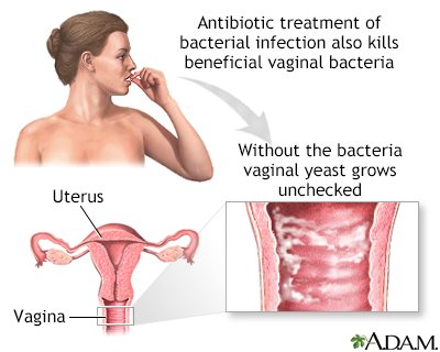 yeast infection bumps women