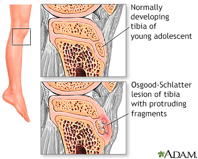 Knee pain Information  Mount Sinai - New York