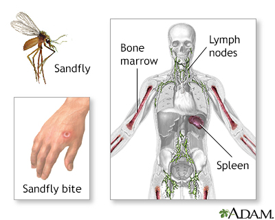 Leishmaniasis - Illustration Thumbnail
                      