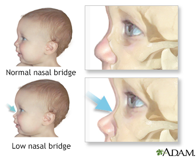 saddle nose syphilis baby