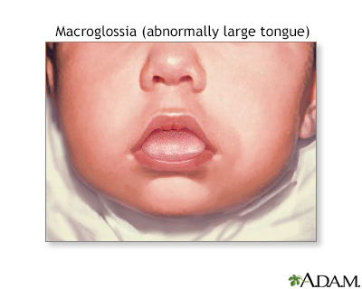 amiloidosis por macroglosia