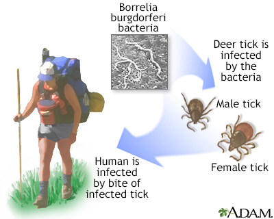 Lyme disease - Illustration Thumbnail              