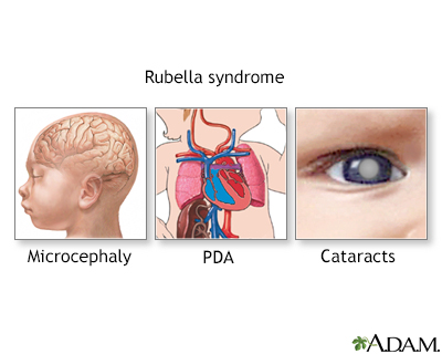 Rubella Syndrome - Illustration Thumbnail              