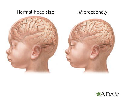 small head disease