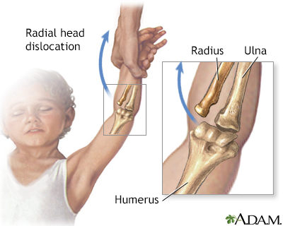 Radial head injury - Illustration Thumbnail
              