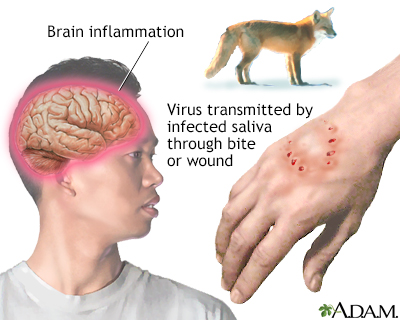 Rabies adalah infeksi virus akut yang ditularkan ke manusia dari gigitan hewan atau luka yang terinfeksi oleh air liur hewan yang menderita rabies. imunisasi diberikan lebih segera (24 - 72 jam) biasanya dapat mencegah tertularnya penyakit.