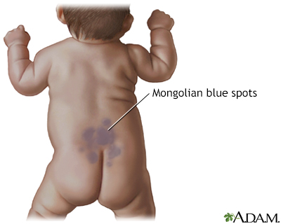 Mongolian blue spots - Illustration Thumbnail
              