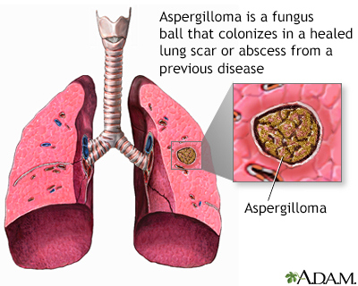 Pulmonary aspergilloma Information | Mount Sinai - New York