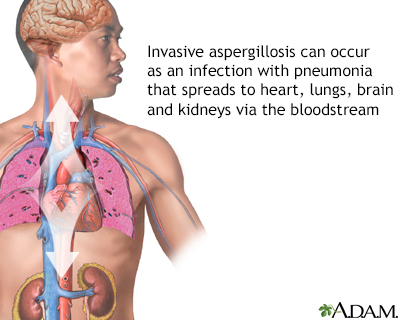 Pulmonary aspergillosis - Illustration Thumbnail
              