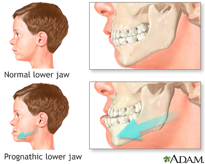 Malocclusion of teeth Information | Mount Sinai - New York