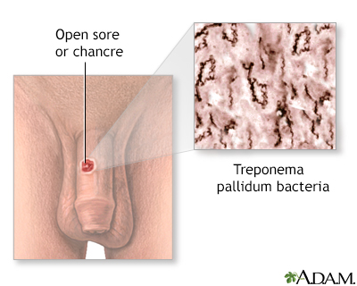 early syphilis in men