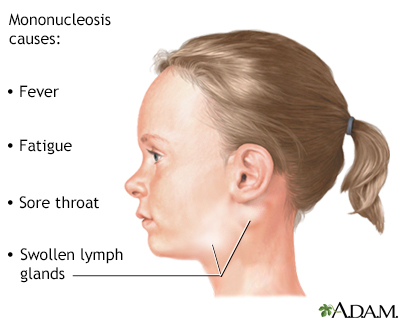 Infectious mononucleosis - Illustration Thumbnail
                      