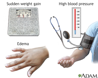 Preeclampsia - Illustration Thumbnail                    