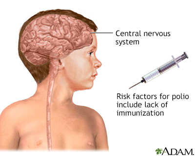 Poliomyelitis - Illustration Thumbnail
                      