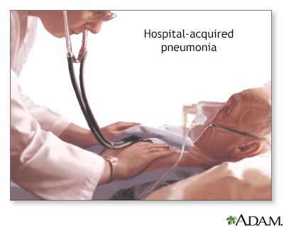 Hospital-acquired pneumonia - Illustration Thumbnail
                      