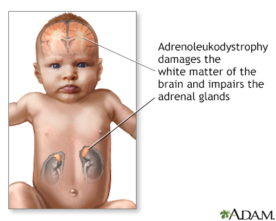 Neonatal adrenoleukodystrophy - Illustration Thumbnail
                      