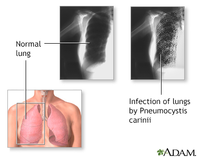 Pneumocystosis - Illustration Thumbnail
                      