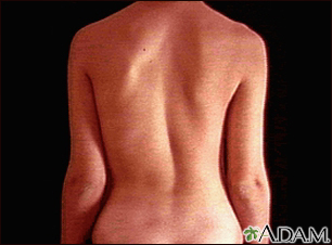 Not Straight - Spine/Scoliosis