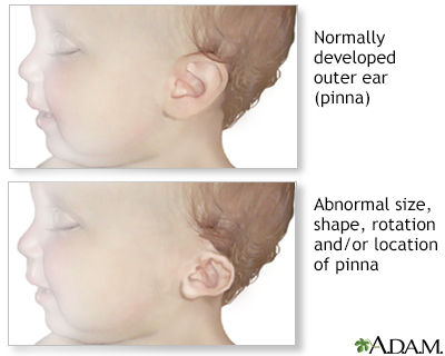 Ear abnormalities - Illustration Thumbnail
              