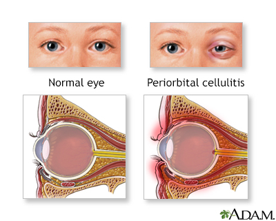 Periorbital cellulitis - Illustration Thumbnail
                      