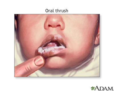 oral thrush lips