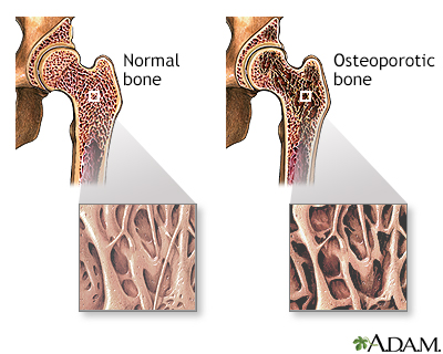 Osteoporosis - Illustration Thumbnail
                      